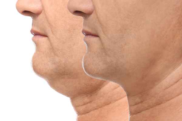 HIFU - Breakthrough in Anti - ageing 2 hifu results Braintree