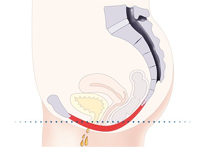 Pelvic-Floor Muscle Repair 5 Pelvic floor muscles Braintree