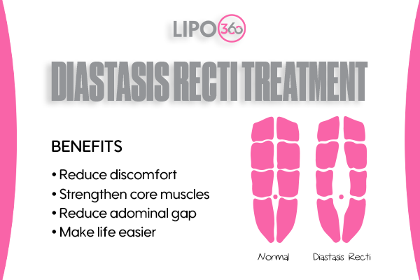 Revolutionising Muscle Repair: The Power of LIPO360 Body Sculpt Post-Injury 5 diastasis recti treatment Braintree