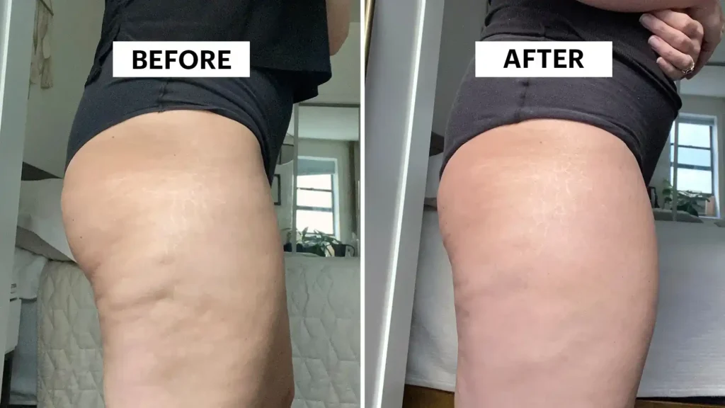 Do Toning Exercise Braintree Really Tackle Cellulite?