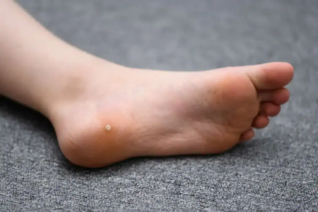 Cryotherapy For Warts And Also Verrucas 2 Image of verruca on the bottom of the foot that able to be treated with Cryotherapy Braintree