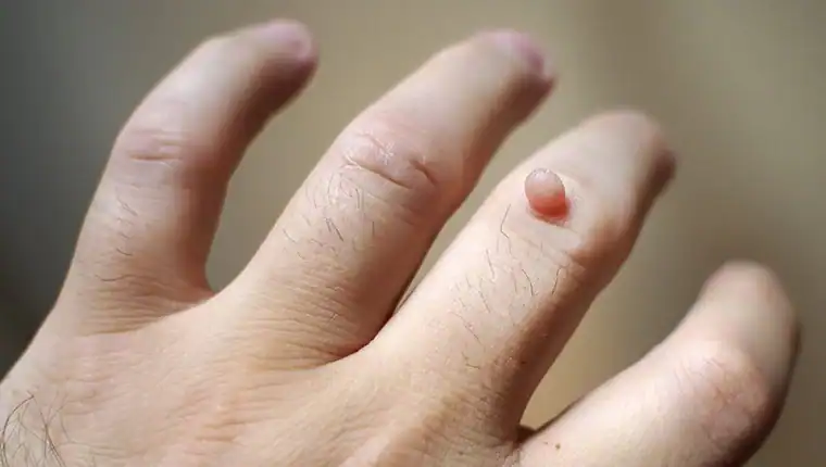 Cryotherapy For Warts And Also Verrucas 1 Image of blemish that Cryotherapy Braintree can remove with Lipo 360.