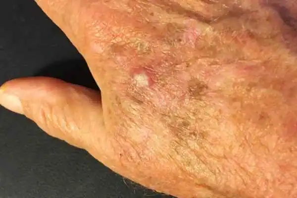Image of Actinic keratoses Braintree on a person hand