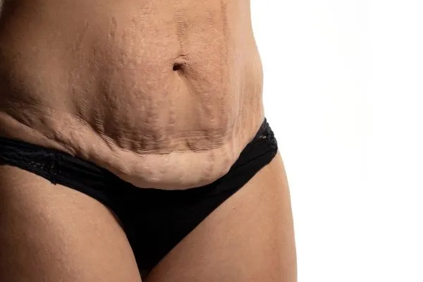 The science behind skin tightening Braintree picture of a woman's sagging skin on the stomach